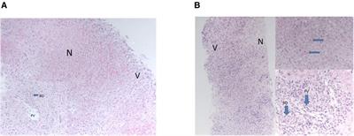 Case report: Acute liver failure in children and the human herpes virus 6-? A factor in the recent epidemic